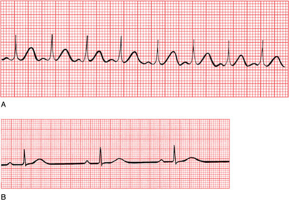 ЭКГ - Medicine Live
